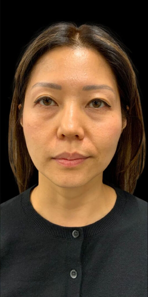 After